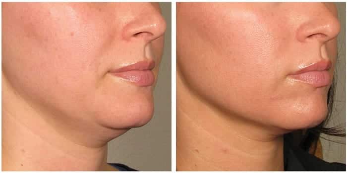 non-surgical-skin-tightening-procedures