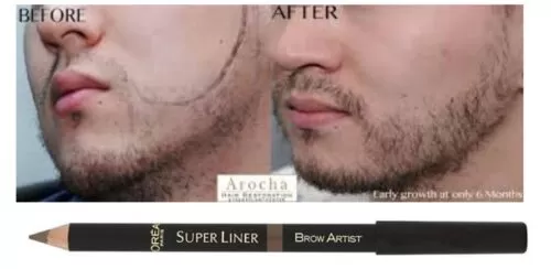 how to fix patchy beard Fillers of patchy beard